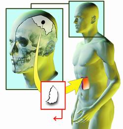  从脑部切出4平方英寸头骨植入腹部肌肉和脂肪层间，3月后再将头骨从腹部取出，移植回头部。新京报制图/丁华勇 