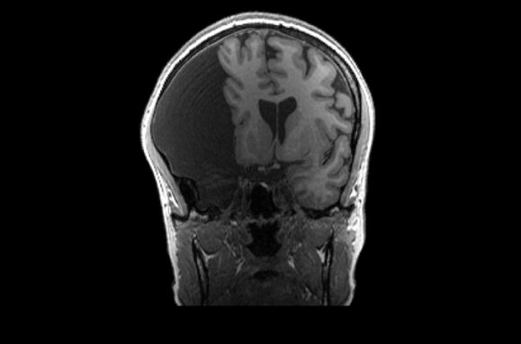 GC 大脑的 MRI 扫描图像显示左侧有一个非常大的黑暗部分，大脑被推向右侧。