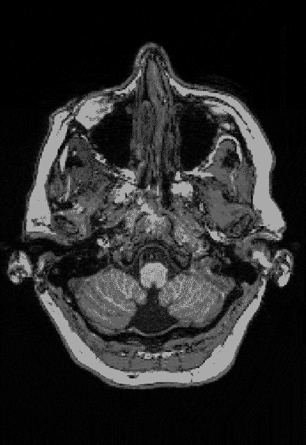 一张 gif 图像，显示了 Elyse G. 的 MRI 扫描结果，以及她左侧大脑的一大块缺失。
