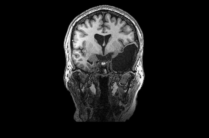 玛莎·M. 大脑的核磁共振扫描，右侧有一个大的黑色部分。