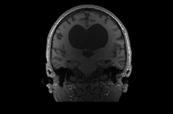 MRI 扫描图像显示 KV 大脑中部有一个心脏形状的大黑色区域。