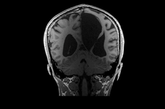 ES 大脑的 MRI 扫描，大脑中部有一个大的和两个较小的黑斑。