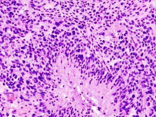 胶质母细胞瘤