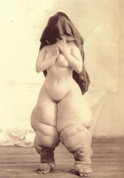 图3，《贝尔维尤的维纳斯》，摄影师Oscar G. Mason最著名的作品之一，拍摄的是一位身患象皮肿的妇女.jpg