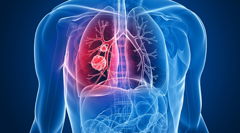 科学家发现易患肺癌者的遗传基因特征