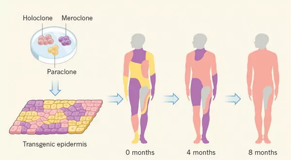 “基因疗法+干细胞”，成功挽救毁灭性皮肤病患儿！