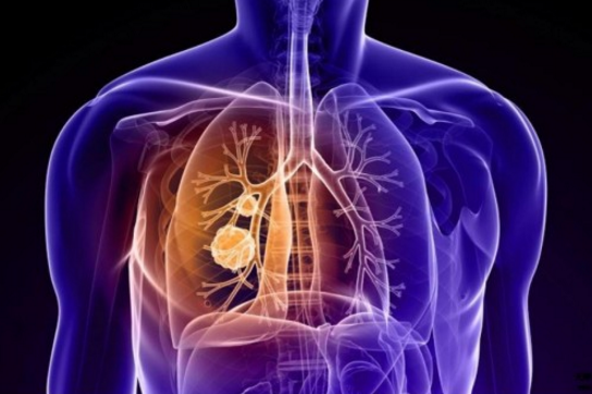 国内最大肺癌社区肺癌帮详解:化疗是痛苦还是救赎?