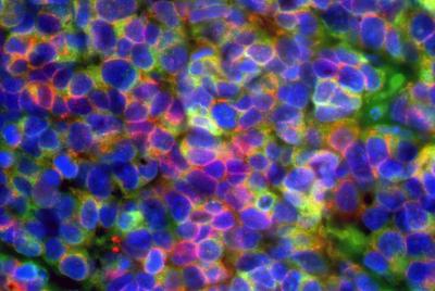 Science：如何将健康细胞癌化？只需这五个基因