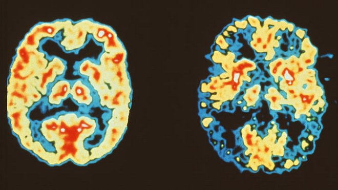 “谜团”甚多！阿尔兹海默症新机制：大脑细胞“篡改”自己的基因