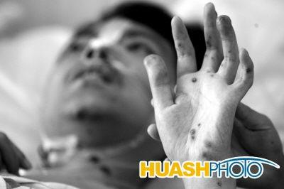 四川男子全身布满100多血管瘤全球仅5例