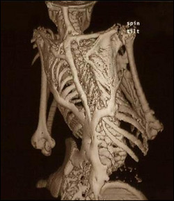 科学家揭开罕见骨病进行性肌肉骨化症之谜：ACVR1基因突变导致骨骼异常生长