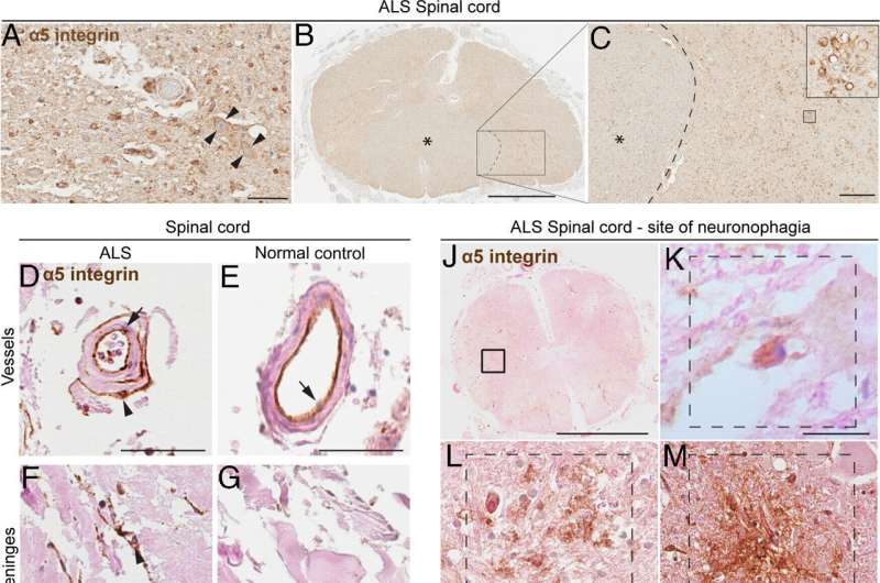 Study raises possibility of immunotherapy treatment for ALS