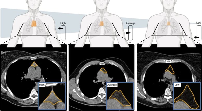 High, Average or Low Thymic Health and Corresponding CT Scans
