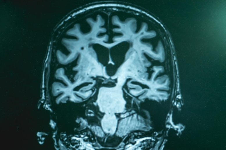 AD新视角:脑细胞基因组三维结构紊乱揭示病理新机制