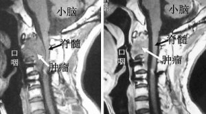 <b>脊索瘤的质子放射治疗：质子治疗离我们有多远？</b>