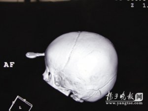 男童额头正中插钥匙：医生实施头皮掀开手术成功取出异物并保全容貌