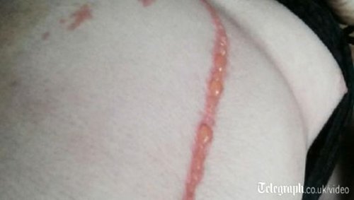 澳男子遭热带蜘蛛“穿膛破肚”寄居腹内数日