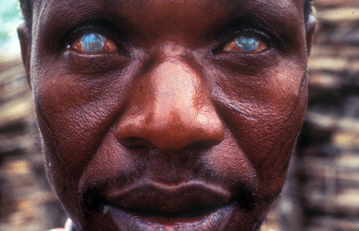 图1，Photo by Pak Sang Lee, Community Eye Health Journal.jpg