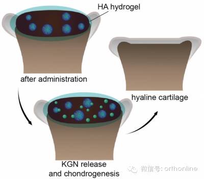 软骨修复领域的革新