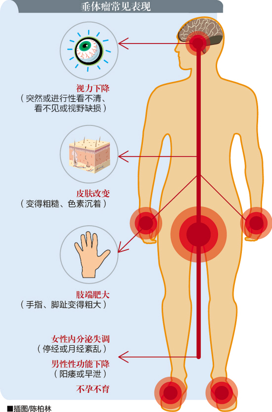 进行性视力下降、视野缺损也可能是垂体瘤