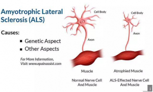 老化干细胞模型加速ALS治疗研究