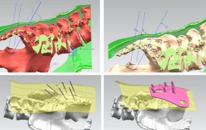 我国全球首例应用3D打印技术治疗功能泌尿疾病获成功