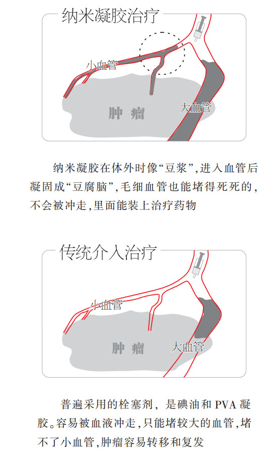 武汉成功研发纳米药能抑制肝癌转移，预计2018年上市