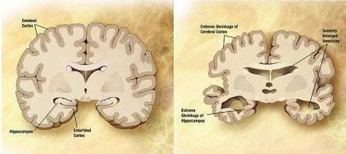 Neurology：重磅！首次发现细菌会直接影响阿尔兹海默式症的疾病进展