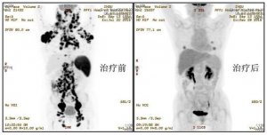 多靶点、多类型CAR-T细胞序贯治疗晚期恶性淋巴瘤的成功案例与最新进展