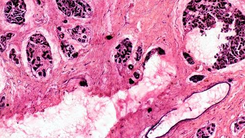 浙大科学家发现已获批糖尿病药物或可以治疗致命性乳腺癌