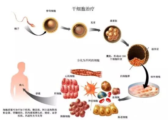 干细胞移植可阻止多发性硬化