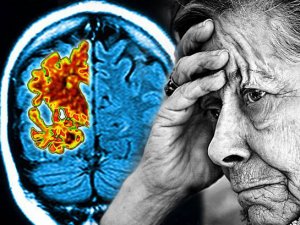 科学家发现与阿尔茨海默症有关的基因 有望有效治疗病症