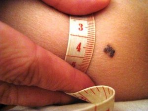 科学家发明新黑色素瘤疗法 复发率或可大幅降低