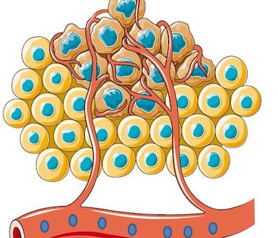 Science Immunology：罕见免疫细胞影响癌症免疫治疗效果