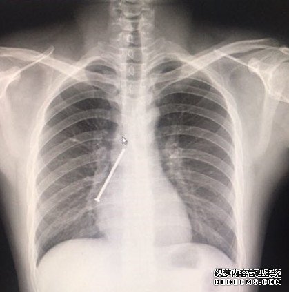 （患者胸片中铁钉样阴影清晰可见）.jpg