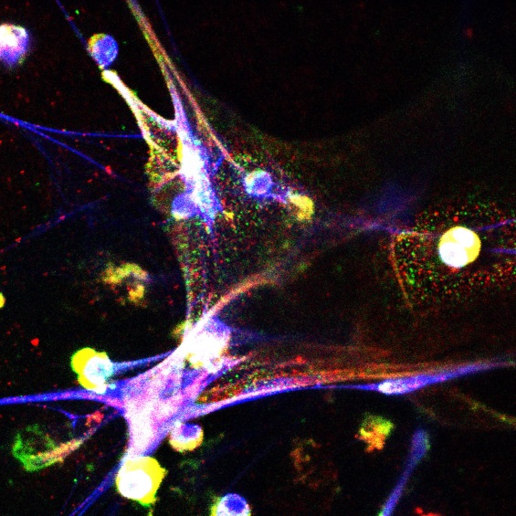 炎症诱导癌症复发？Science揭示：唤醒休眠癌细胞的信号