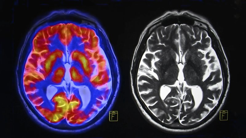<b>脑成像揭示自闭症两大生物学亚型</b>