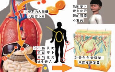 11岁男孩吃橘子过量 导致全身呈现橘黄色(图)